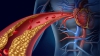 Hipercolesterolemia Familiar pode aumentar em 30 vezes o risco de problemas cardíacos